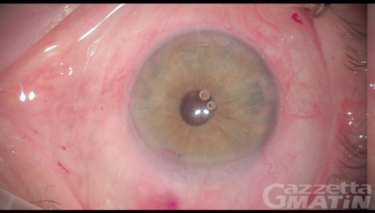 Sanità: in Valle d’Aosta primo intervento mini invasivo su glaucoma