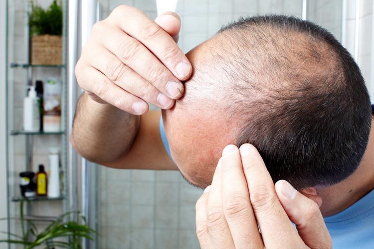 Alopecia: fino a 600 euro di contributo per l’acquisto di parrucche