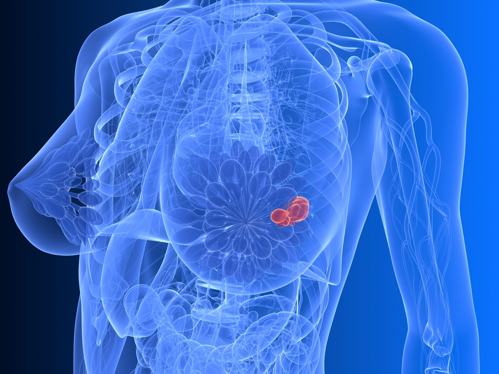 Tumore al seno, il test genomico ha evitato la chemio al 70% delle pazienti valdostane